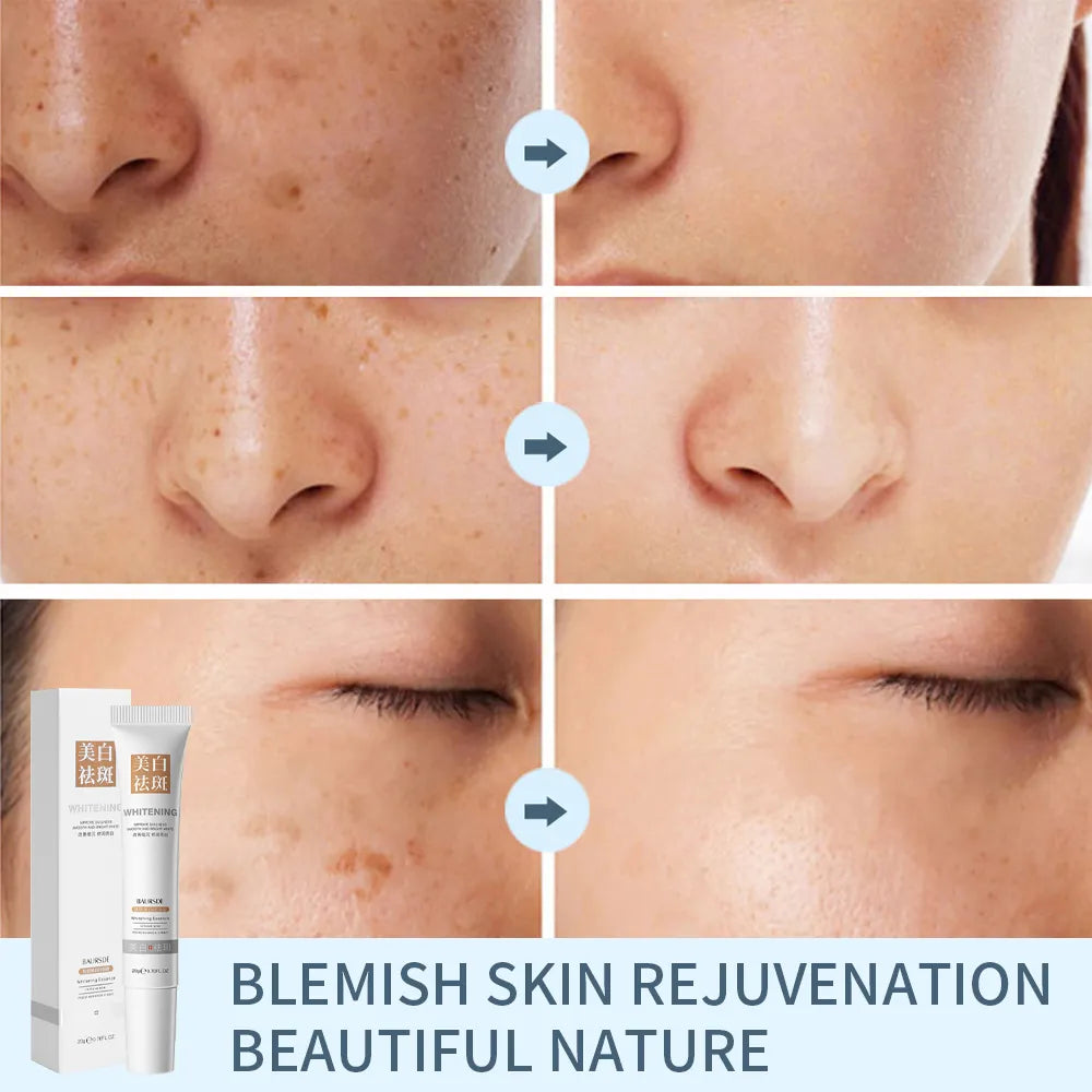 Whitening Freckle Removal Cream Remove Melasma Fade Melanin Anti-Pigmentation Improve Dullness Brighten Skin Care