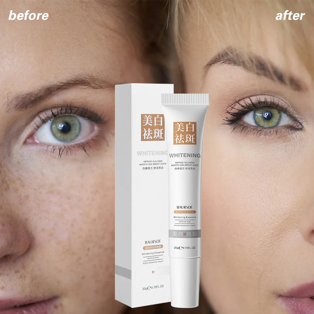 Whitening Freckle Removal Cream Remove Melasma Fade Melanin Anti-Pigmentation Improve Dullness Brighten Skin Care