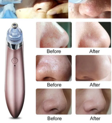 Black Head Remover Machine XN 8030 Rechargeable Pore Cleaner Vacuum Negative Pressure Acne Pore Cleanser 4 Changeable Head